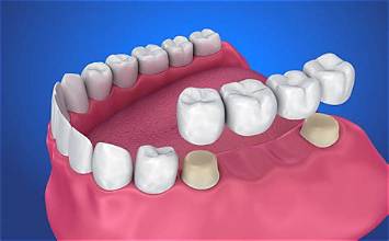 Dental crowns and a bridge replacing and protecting teeth