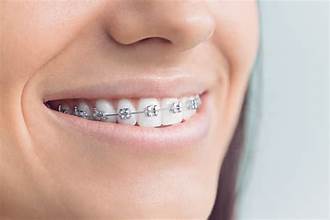 Orthodontic braces used to align teeth