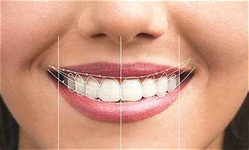 Smile restoration with cosmetic dental treatment